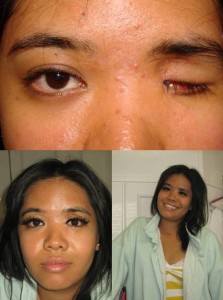 Anophthalmia before and after