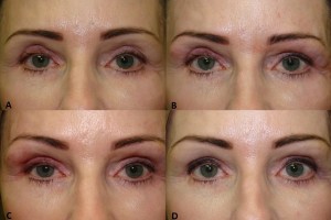 Blepharoplasty  remedied with filler - before & after.