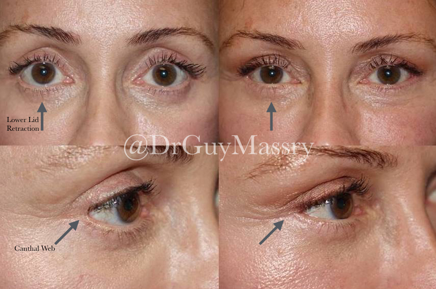 Lower eyelid retraction and canthal web