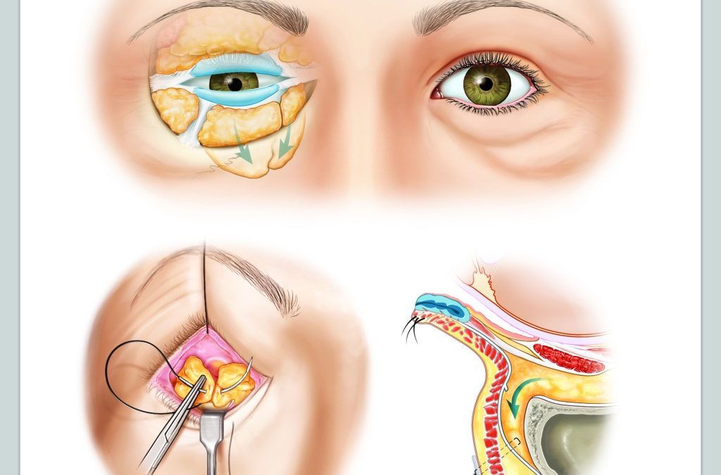 How To: Perform Lower Lid Blepharoplasty With Fat Transpositioning