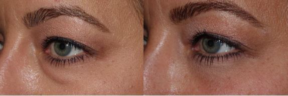 Lower Blepharoplasty – Why Fat Preservation is Essential