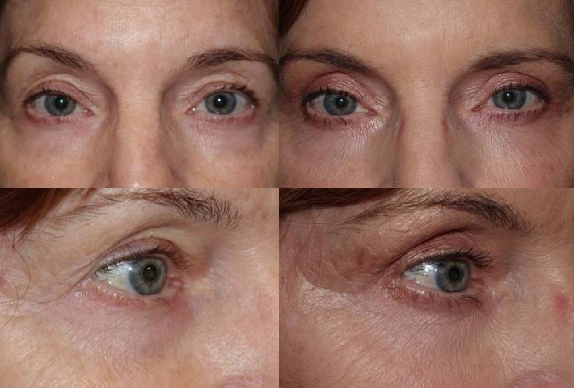 Treatments For Bags Under The Eyes  Dallas  Plano Texas Cosmetic  Reconstructive Eye Surgery