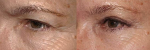 Outer brow lift and upper blepharoplasty
