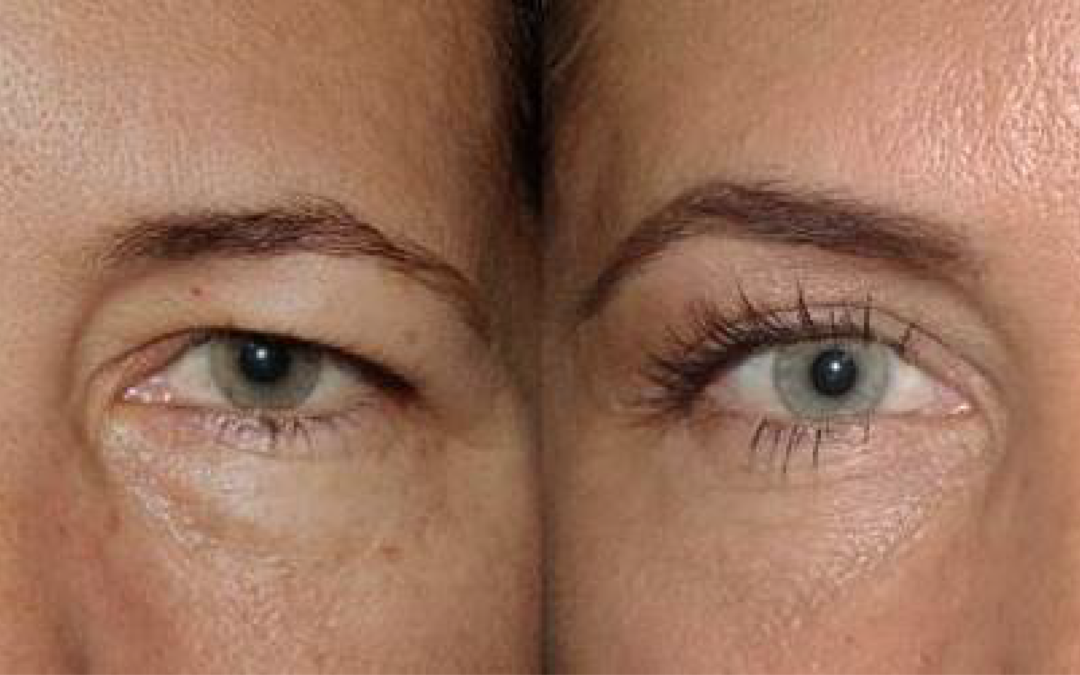 The Real Deal with Brow Lifts