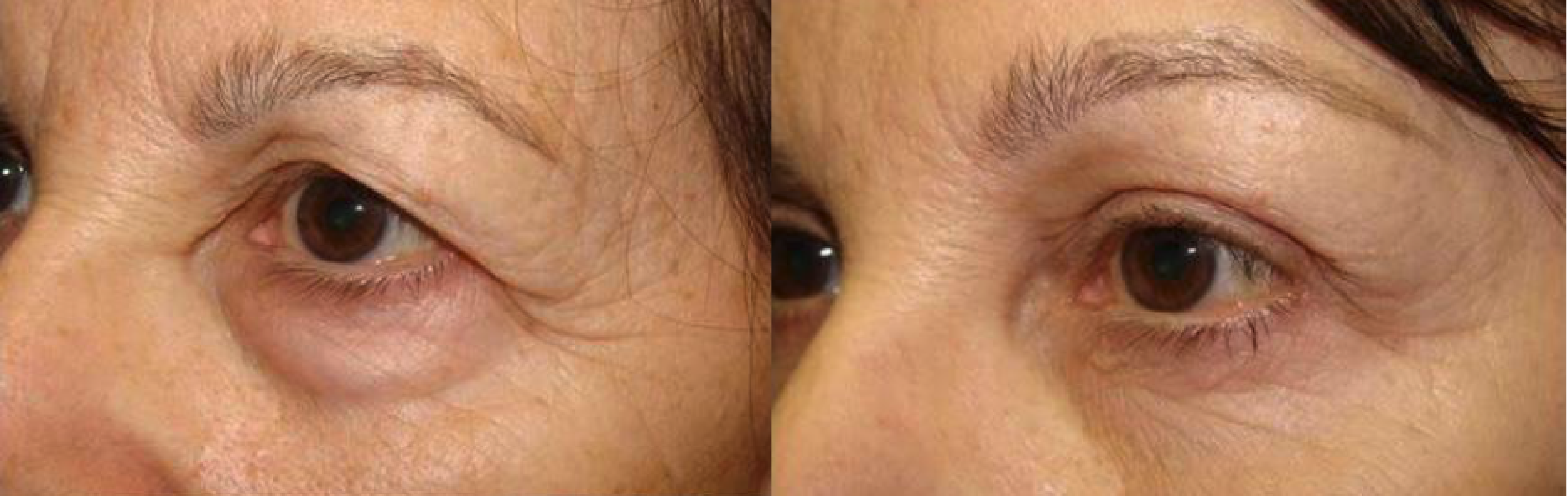 Hollow Upper Eyelids – The Best Way to Fix Them
