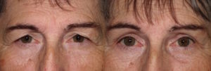 Brow lift with eyelid surgery to make brows symmetrical