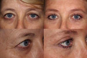 Brow lift, upper and lower blepharoplasty, and ptosis repair (left)