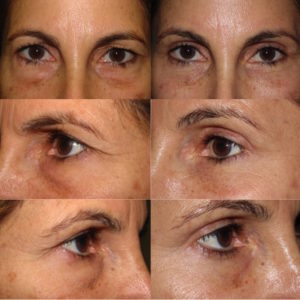 Brow lift, upper and lower blepharoplasty, and fat repositioning