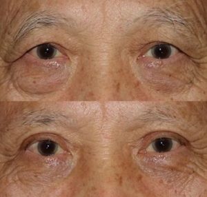 Brow Lift with upper and lower Blepharoplasty