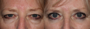 Classic Upper and Lower Blepharoplasty