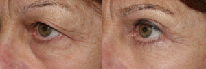Outer brow lift with upper and lower blepharoplasty