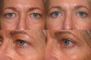 Customized Eyelid Rejuvenation - Upper and Lower Blepharoplasty