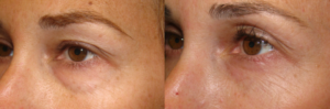 Customized cosmetic eyelid surgery