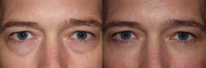 Eye Bag Surgery - Lower Blepharoplasty