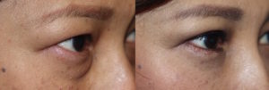 Lower Blepharoplasty - Under eye bag surgery