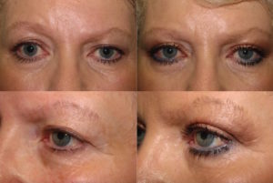 Upper Blepharoplasty and brow lift