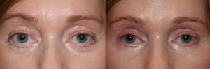 Lower Eyelid retraction repair