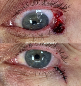 Eyelid skin cancer removal