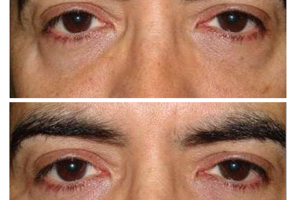 Restylane Fillers under the eyes
