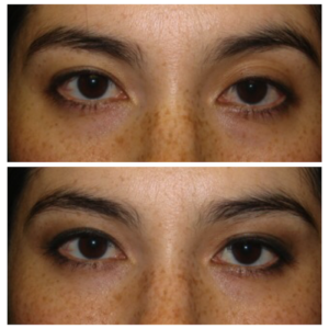 Restylane filler in upper eyelids