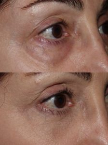 Lower Blepharoplasty - Under eye bag removal