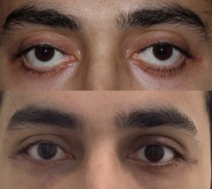Eyelid retraction repair