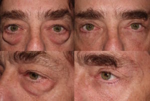 Lower and upper blepharoplasty and brow lift
