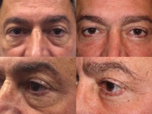 Male lower blepharoplasty with fat repositioning