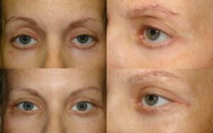 Lower eyelid retraction surgery