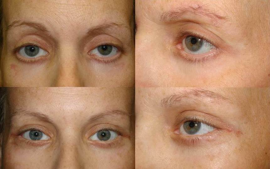 Lower eyelid retraction surgery Dr. Guy Massry