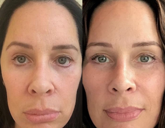 Lower Eyelid Retraction – How To Fix Bad Blepharoplasty Results