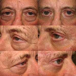 Male Upper and Lower Blepharoplasty, Browlift, Fat Transposition, Ptosis Repair, and Festoons