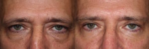 Male brow lift with upper and lower blepharoplasty