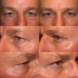 Upper and lower blepharoplasty with fat repositioning - Male Blepharoplasty