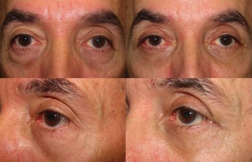 Lower Lid Blepharoplasty with Fat Repositioning & Fat Graft to Cheeks