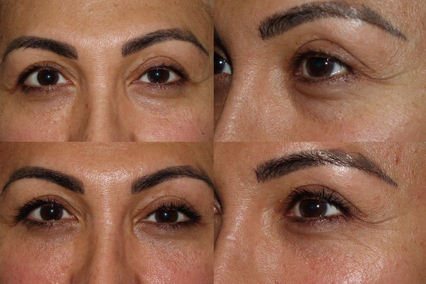 Lower Blepharoplasty with fat grafting and fat repositioning