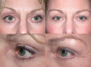 Canthoplasty with lower lid retraction repair