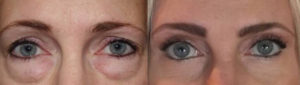 Fat grafting repair, outer brow lift, and upper and lower blepharoplasty