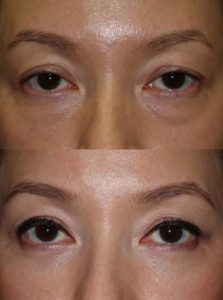 Lower blepharoplasty with fat repositioning