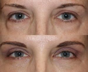 Upper and lower blepharoplasty with fat repositioning