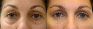 Under eye bag removal - Lower blepharoplasty