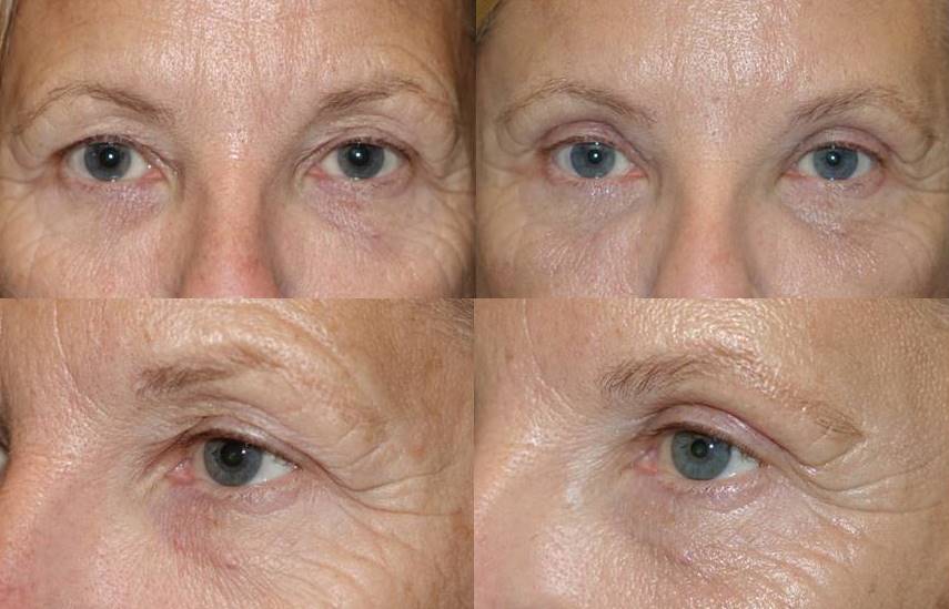 Upper Blepharoplasty with fat grafting