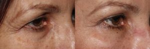 Upper and lower blepharoplasty, fat repositioning, and brow lift