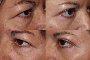 Upper Blepharoplasty - Eyelid Rejuvenation Surgery