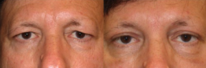 Male upper blepharoplasty and brow lift