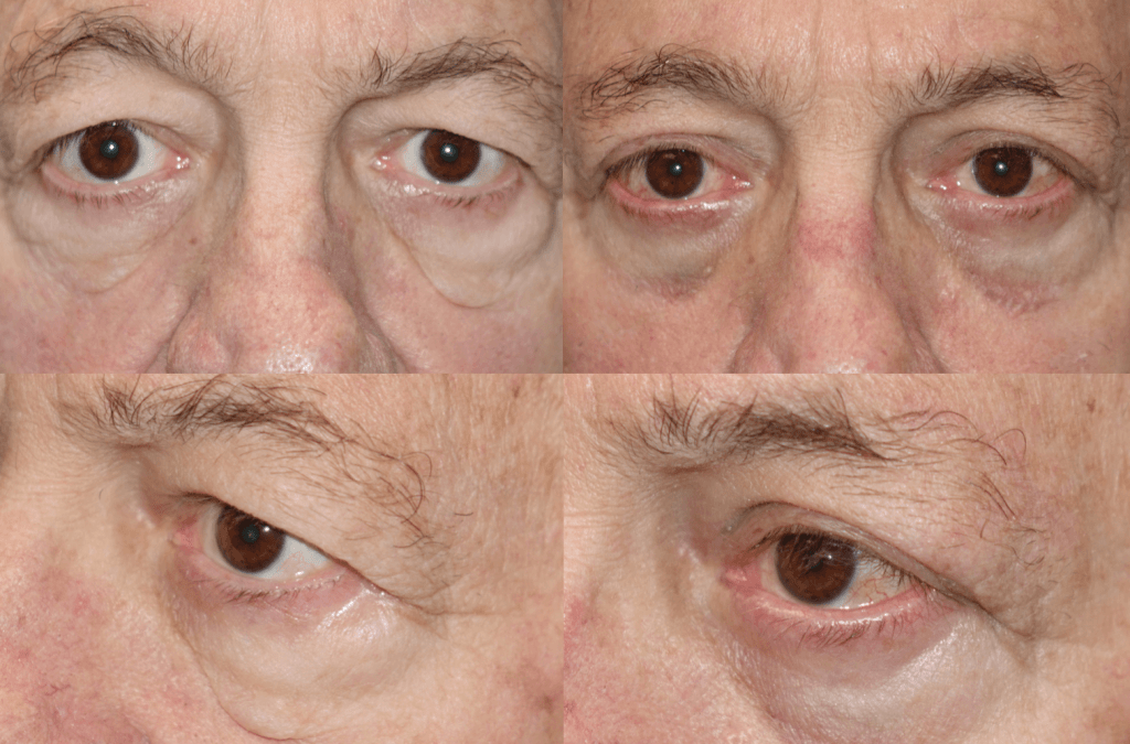 Male Blepharoplasty – Age Appropriate Results Are Key