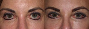 Lower lid ectropion revision and upper ptosis repair