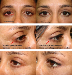 Canthoplasty With Horizontal Eyelid Lengthening