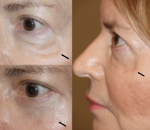 Eyelid Contour Correction Graft (ECCG) - Revisional fat grafting repair