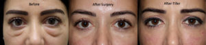 Fat grafting repair with under eye filler